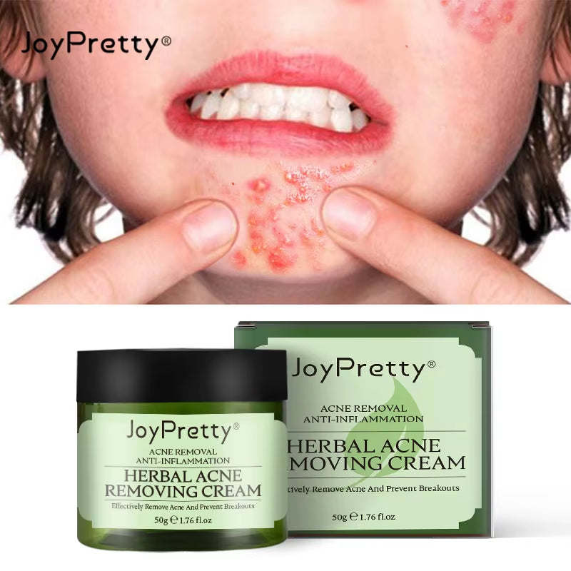 Joypretty Herbal Acne Removal Face Cream: Pimple Treatment and Moisturizing Repair for Clearer Skin